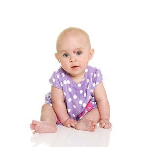 Hemangiomas.jpg