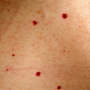 Strawberry Nevus and Other Birthmarks in Pictures | Med ...