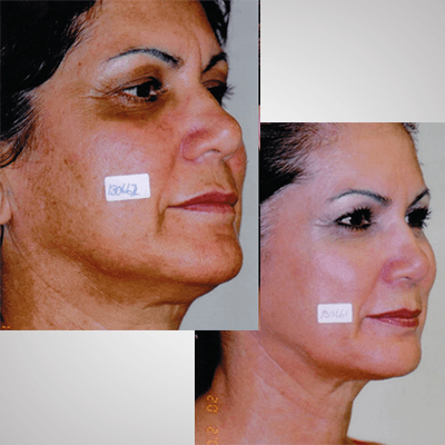 Best Skin Rejuvenating Procedures