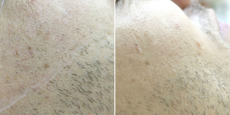 Laser Hair Removal Chesapeake Laser Skin Treatments | Male Models ...