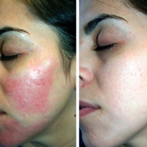 Pigmentation Treatment Can Safely Brighten Your Skin
