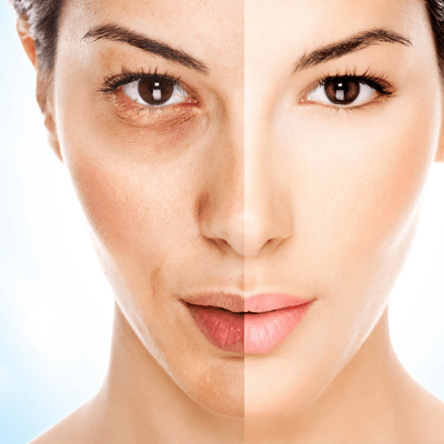  Chemical Peels for acne scars