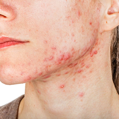 pimples treatment dubai