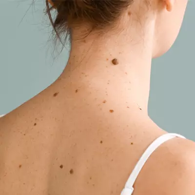 Skin Moles-What Causes Them and How to Deal With Them?