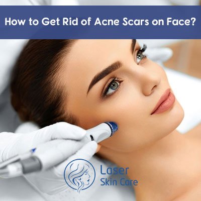 Acne-Scar-Treatment.jpg