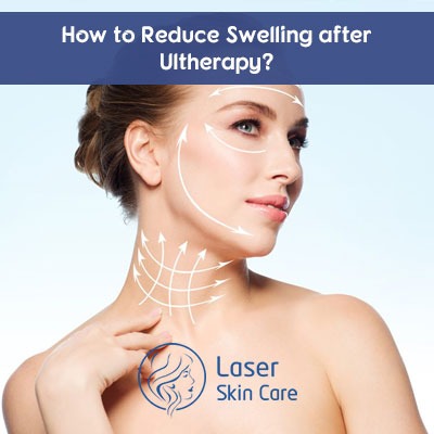 How to Reduce Swelling after Ultherapy