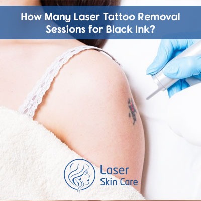 How Many Laser Tattoo Removal Sessions for Black Ink?