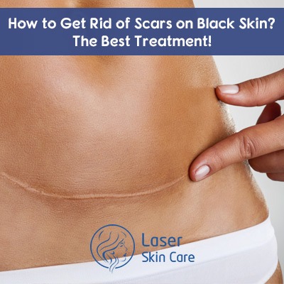 How to Get Rid of Scars on Black Skin