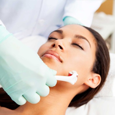 Microneedling for Ice Pick Acne Scars