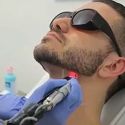 Beard Laser Hair Removal in Dubai | Skin Care Clinic UAE