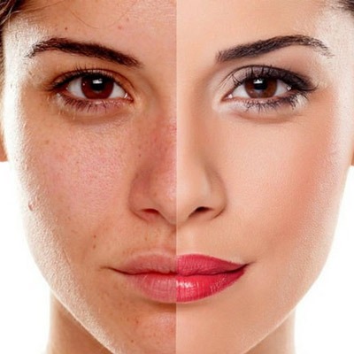 Microdermabrasion Treatment Cost In Dubai