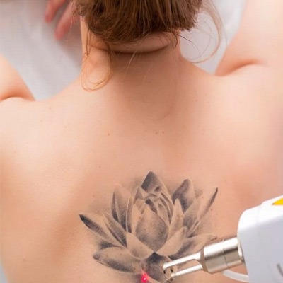 Bad Ink - Recognizing When It's Time for Laser Tattoo Removal