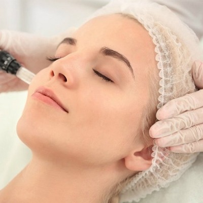 Reasons to Take Micro Needling Treatment for Acne Scars