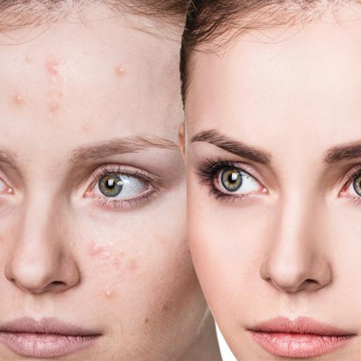Is Laser Treatment for Acne Good or Bad