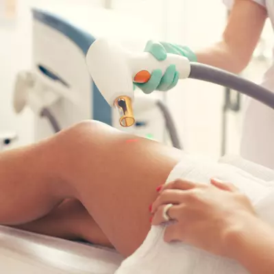 Reasons to Use Laser Therapy for Stretch Marks Removal
