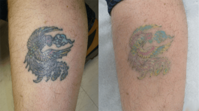 Best Tattoo Removal for Green Ink - Laser Skin Care Clinic