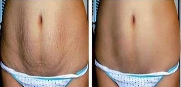stretch marks removal before and after