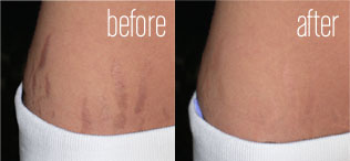 stretch marks removal before and after