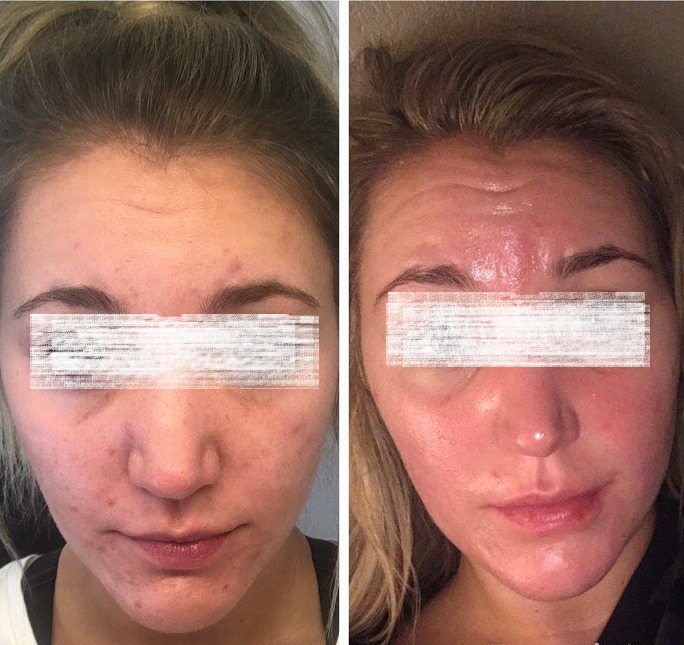 microdermabrasion treatment before and after