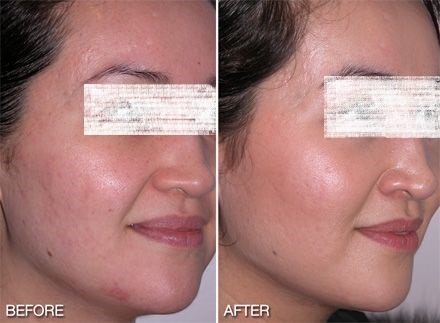 microdermabrasion treatment before and after