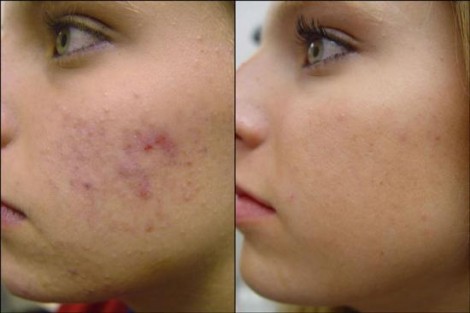 Radio Frequency Treatment for Acne Scars in Abu Dhabi