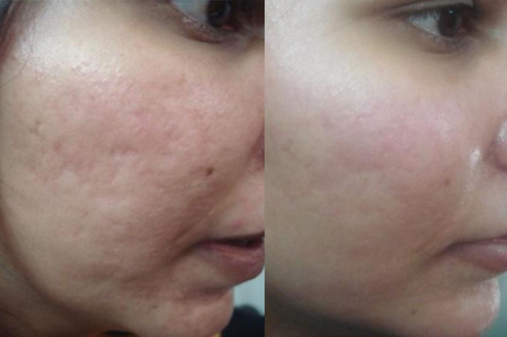 Radio Frequency Treatment for Acne Scars in Dubai