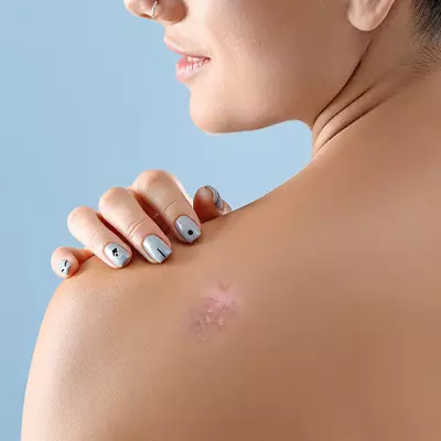 Signs of Infection After Laser Tatoo Removal - Laser Skin Care