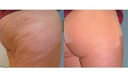 Best Cellulite Removal Treatment - Dubai