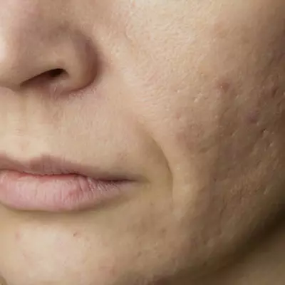 Large Pores Treatment