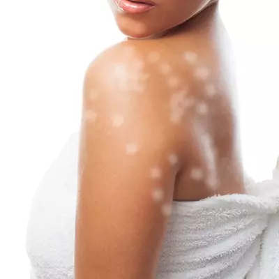 How to Get Rid of White Spots on Skin from Sun