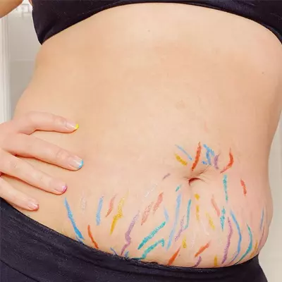 Can Tattoos Cover Stretch Marks?