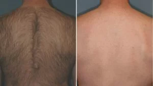 Laser Hair Removal Before And After