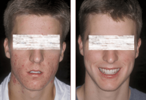 Acne Scar Treatment Before and After