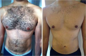 Men Laser Hair Removal in Dubai