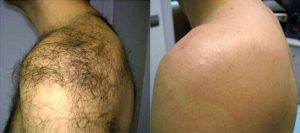 Laser Hair Removal for Men In Dubai
