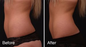 Non-Surgical Fat Reduction Treatments Result